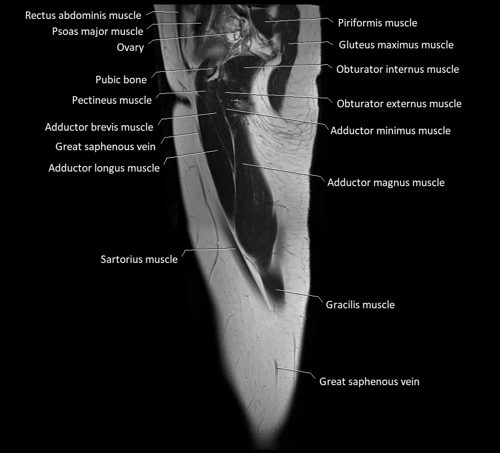 Thigh sagittal cross sectional anatomy MRI 3T image 18.webp
